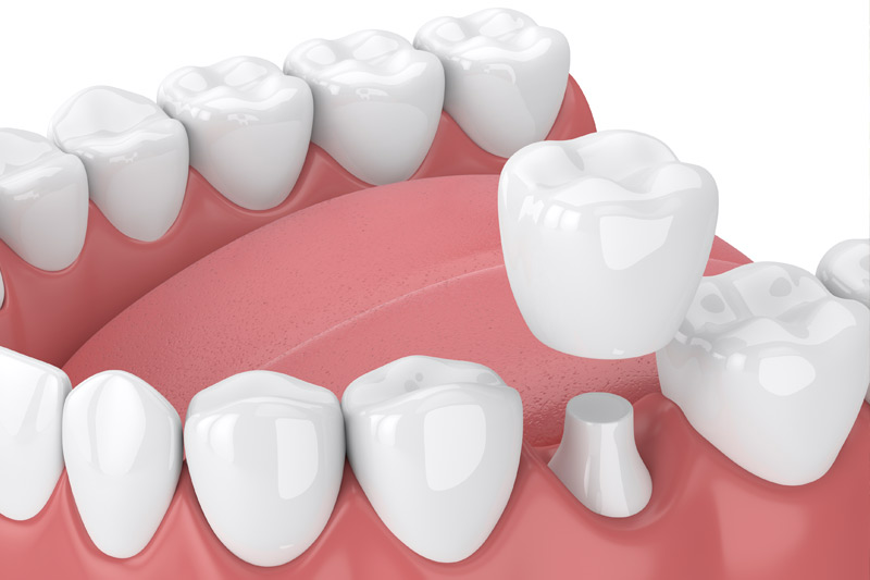 Dental Crowns in Greer