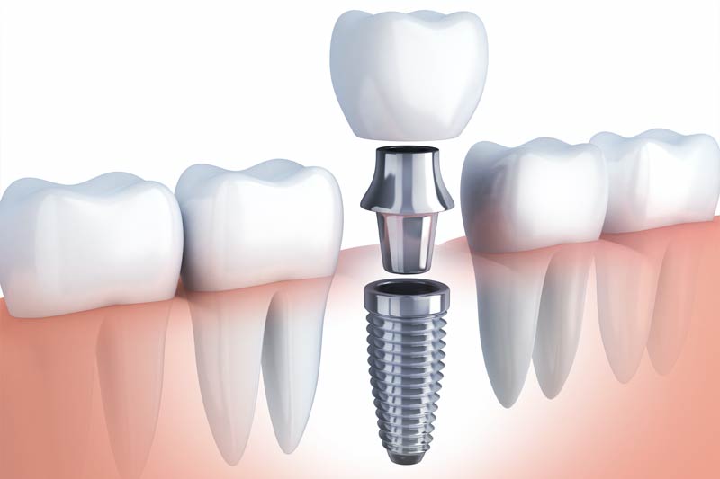Implants Dentist in Greer